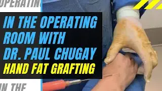 Hand Fat Grafting Surgery - Before & After, Reduce Veins in Hands, Younger Hands