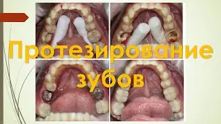 Секреты Стоматологии - Глава 4. Протезирование.(Коронки, Виниры)