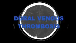 Clinical case - Dural venous sinus thrombosis and cortical venous thrombosis with infarct