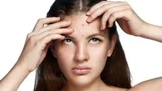 BIG Blackheads Removal   Acne Treatment   SPA ASMG   Blackheads on face LIVE4