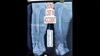 Lost Bone in Accident, fracture,Road traffic accident, Bridging callus,Bone graft