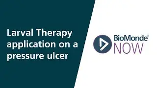 Larval Therapy Application on a Pressure Ulcer | Wound Care Case Studies