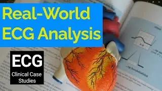 Real-World ECG Analysis: Clinical Case Studies in Electrocardiography.