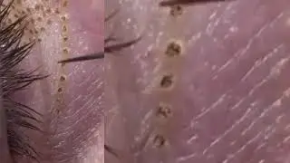 FibroblastPlasma