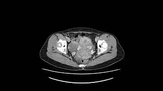 pelvic venous congestion