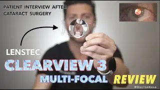 Lenstec CLEARVIEW 3 MultiFocal IOL Review | Cataract Surgery | Real Patient Feedback | No glasses!