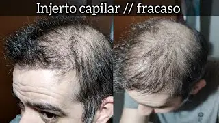 Mi desastre en Turquía con Dr.Songul Alci en clínica MÉDICANA // INJERTO CAPILAR