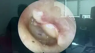 #Endoscopic type 1 #tympanoplasty ; procedure can be performed using the transcanal approach.