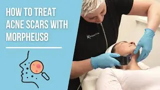 How To Treat Acne Scars & Improve The Look Of Your Skin With Morpheus8