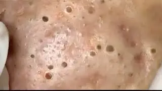 Acne Treatment Blackhead Extractions Popping #85