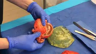 En Bloc removal of 29 year old silicone implants