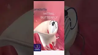 Mitral Valve Regurgitation - Corrected by Mitral Butterfly