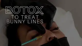#BOTOX TO TREAT BUNNY LINES