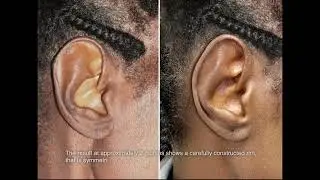 Dr. John E. Sherman - Correction of Helical Rim Abnormality