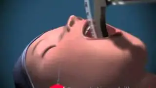 Endotracheal Intubation   Animated
