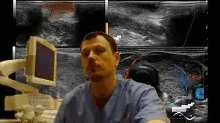 Pediatric Soft tissue & Thyroid ultrasound - Recurrence of the thyroglossal cyst and AIT