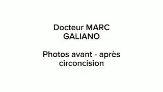Photos circoncision  2019 avant-après opération