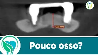 Planejamento digital para a instalação de implantes em regiões limítrofes