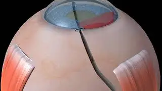 corneoscleral laceration limbal suture animation