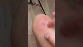 Как избавиться от укуса тарантула. Проверка и последствия укуса.