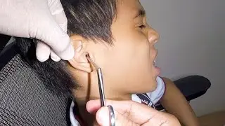 Something Stuck Deep in Boy's Ear | What is it?