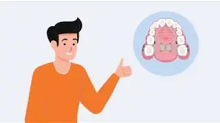 MARPE instruction; what you need to know for MARPE; MSE (maxillary skeletal expander)