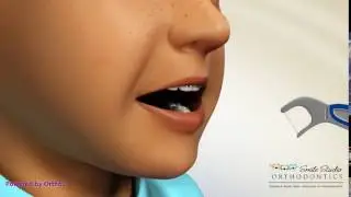 Orthodontic Flosser