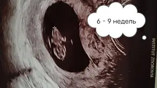 6-9  недель моей не легкой беременности.Гематома.УЗИ.Токсикоз МОЙ ТЕЛЕГРАММ  t.me/ lt8-usM5_IpjZTMy