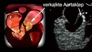 Percutane aortakunstklepimplantatie