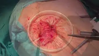 Laparoscopic Complete Mesocolic Excision Extended Right Colectomy (SMV-First Approach)