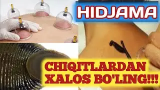 Hidjama foydalari, kimlarga mumkin emas, Zulik qo'yish