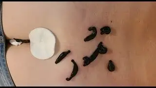 Можно ли геморрой лечить пиявками?
