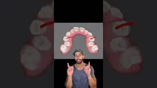 Invisalign case review, smile design, timelapse, and before after.