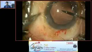 KSOS2023   GP18  Topic Dr Sudeep Das  Premium IOL implantation in difficult scenarios