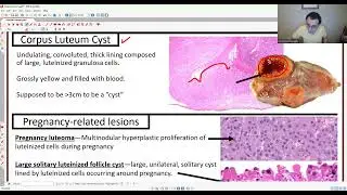 GYN PATHOLOGY: OVARIAN TUMORS 1