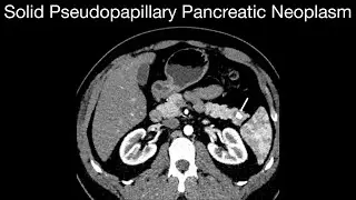 Solid Pseudopapillary Pancreatic Neoplasm