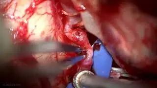 Excision and Double Reanastomosis of Dolichoectatic p2 Posterior Inferior Cerebellar Artery Aneurysm