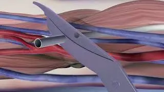 HeRO® Graft Adapter Implant Overview