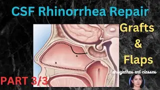 236.Endoscopic Repair CSF Rhinorrhea: Grafts and Flaps- Part 3/3 #surgeryeducation #dentallectures