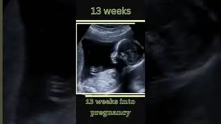 5-14 Weeks Embryo To Fetus Appearance On Ultrasound | ultrasound 