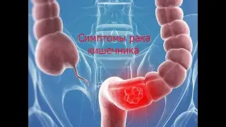 Важные симптомы рака кишечника