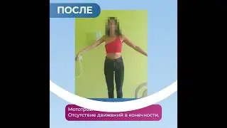 Плечевое нервное сплетение. Результат операции. НИИ Микрохирургии,  г.Томск