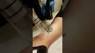 देखें कैसे tatto निकला जाता है | Watch This is how Tatto got removed # Satisfying