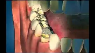 Porcelain Fused to Metal Crown - Miskin Ajax Dental