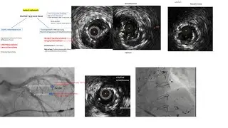 Instent restenosis: approach and cases