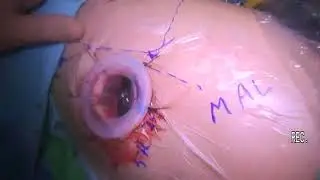 Hybrid Uniportal VATS Technique for Left Upper Lobectomy With Chest Wall Resection, Reconstruction