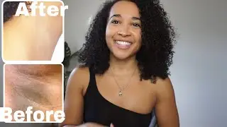 How I Lighten and Get Rid of My Dark Armpits FAST!