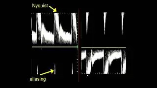 Fundamentals of Doppler ultrasound physics 