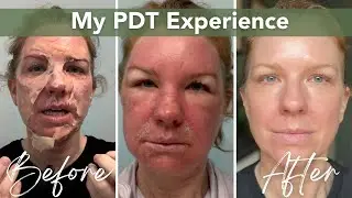Skin Cancer Prevention - PDT (Photodynamic Therapy)