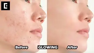 Tutorial Menghilangkan Jerawat Cepat Dan Mudah Cukup Di HP I Epik Tutorial